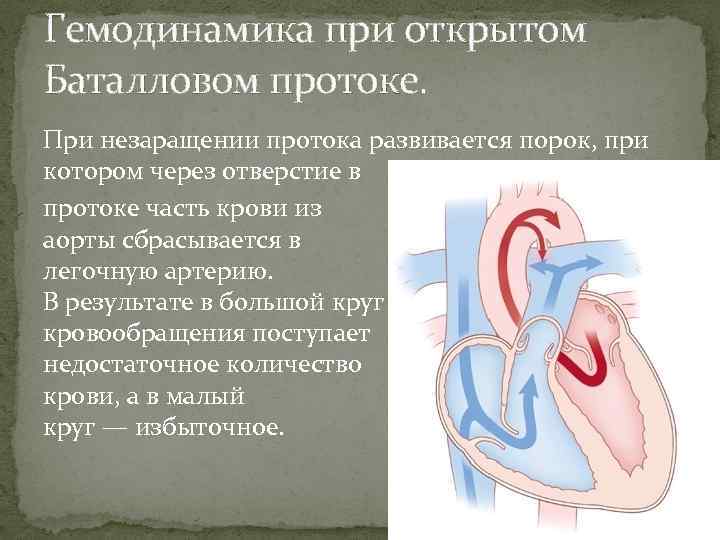 Схема открытого артериального протока