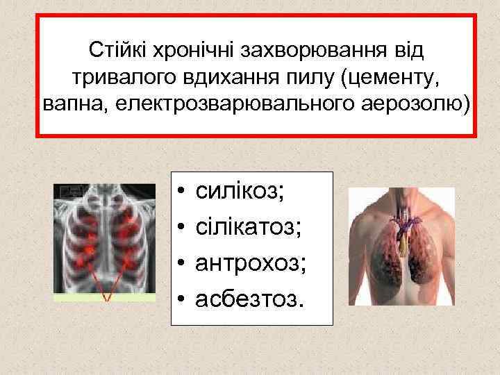 Стійкі хронічні захворювання від тривалого вдихання пилу (цементу, вапна, електрозварювального аерозолю) • • силікоз;