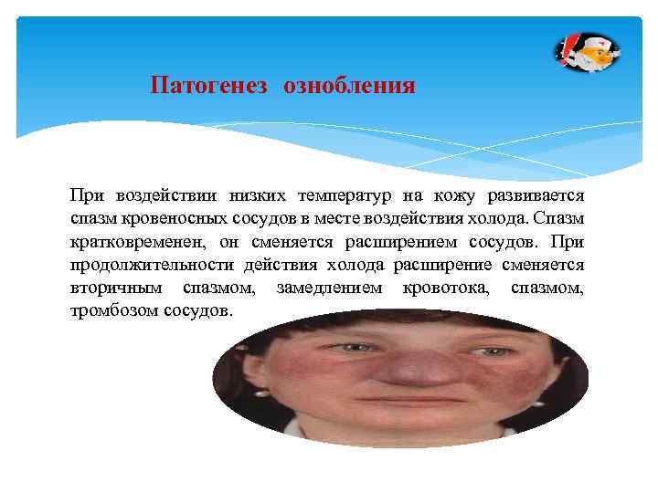  Патогенез ознобления При воздействии низких температур на кожу развивается спазм кровеносных сосудов в