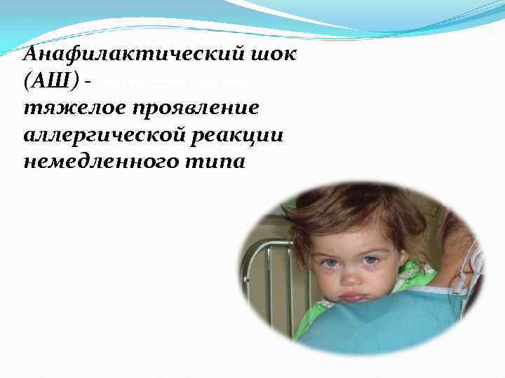 Анафилактический шок (АШ) - максимально тяжелое проявление аллергической реакции немедленного типа 