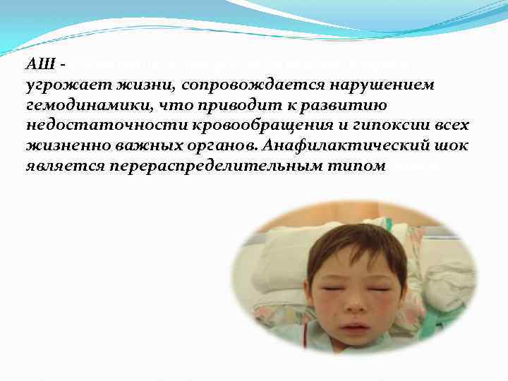 АШ - состояние, которое возникает остро и угрожает жизни, сопровождается нарушением гемодинамики, что приводит