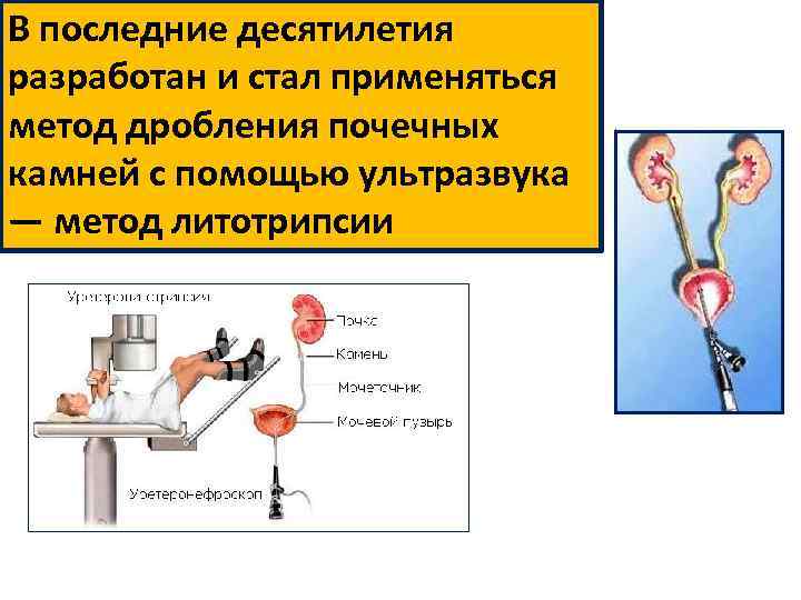 В последние десятилетия разработан и стал применяться метод дробления почечных камней с помощью ультразвука