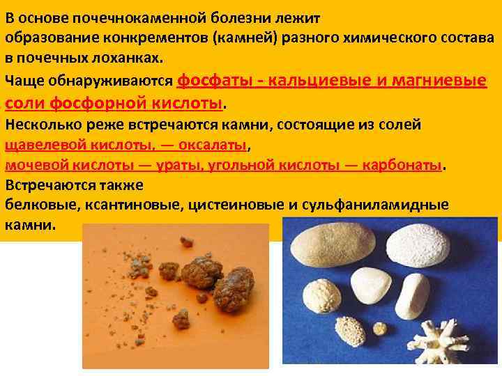 Ксантиновые камни в почках фото и описание