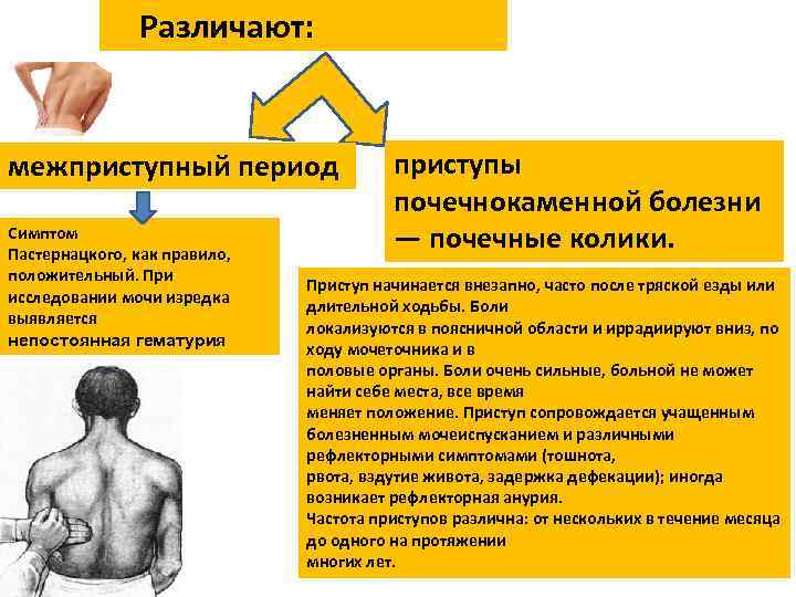 Симптом пастернацкого картинки