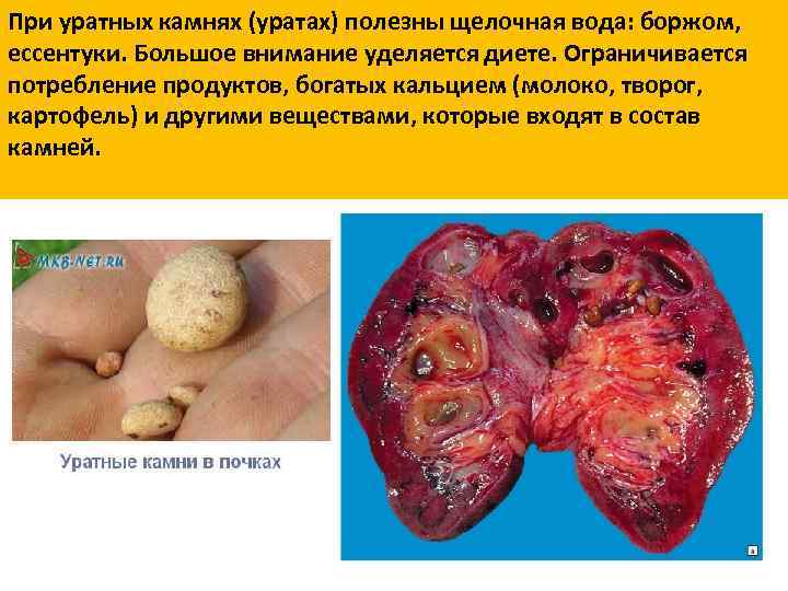 При уратных камнях (уратах) полезны щелочная вода: боржом, ессентуки. Большое внимание уделяется диете. Ограничивается