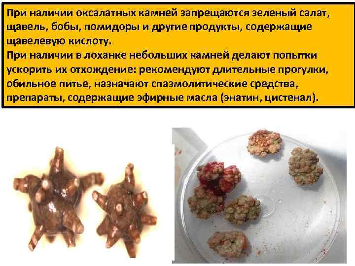 При наличии оксалатных камней запрещаются зеленый салат, щавель, бобы, помидоры и другие продукты, содержащие