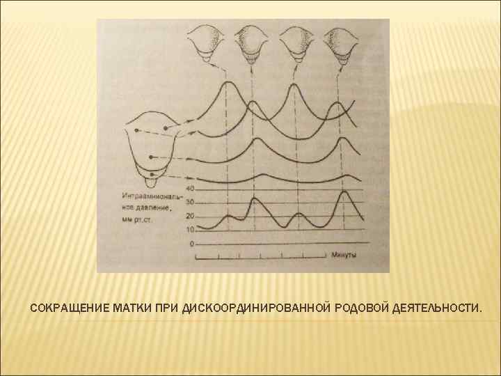 СОКРАЩЕНИЕ МАТКИ ПРИ ДИСКООРДИНИРОВАННОЙ РОДОВОЙ ДЕЯТЕЛЬНОСТИ. 