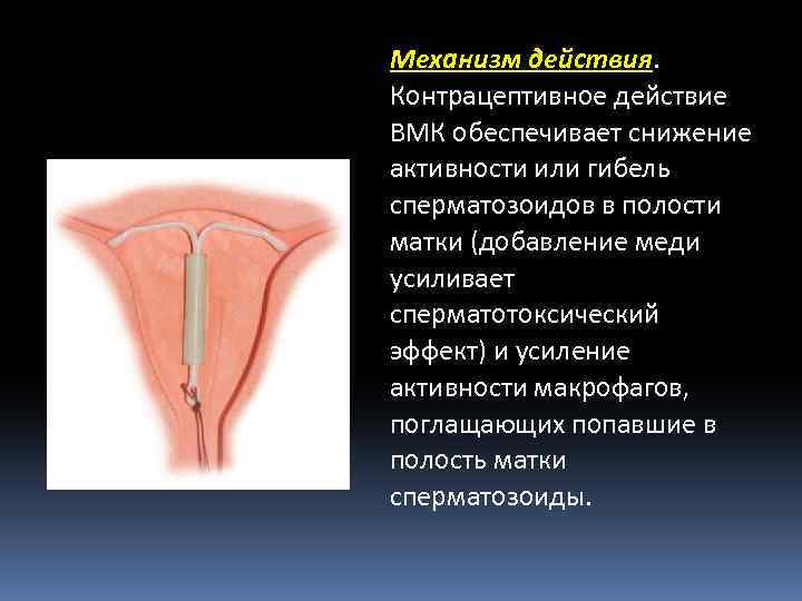Механизм действия. Контрацептивное действие ВМК обеспечивает снижение активности или гибель сперматозоидов в полости матки