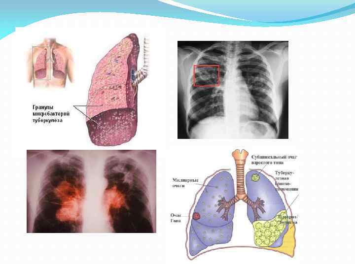 Гематогенный туберкулез презентация