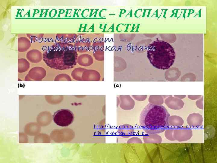 КАРИОРЕКСИС – РАСПАД ЯДРА НА ЧАСТИ http: //lizzy. clan. su/news/kachestvennye_narushe nija_lejkocitov_krovi_d… 