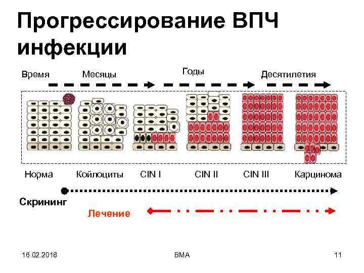 Прогрессирование ВПЧ инфекции Время Норма Годы Месяцы Койлоциты CIN II Десятилетия CIN III Карцинома