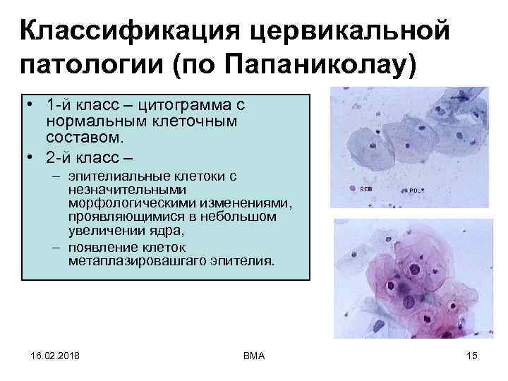 Классификация цервикальной патологии (по Папаниколау) • 1 -й класс – цитограмма с нормальным клеточным