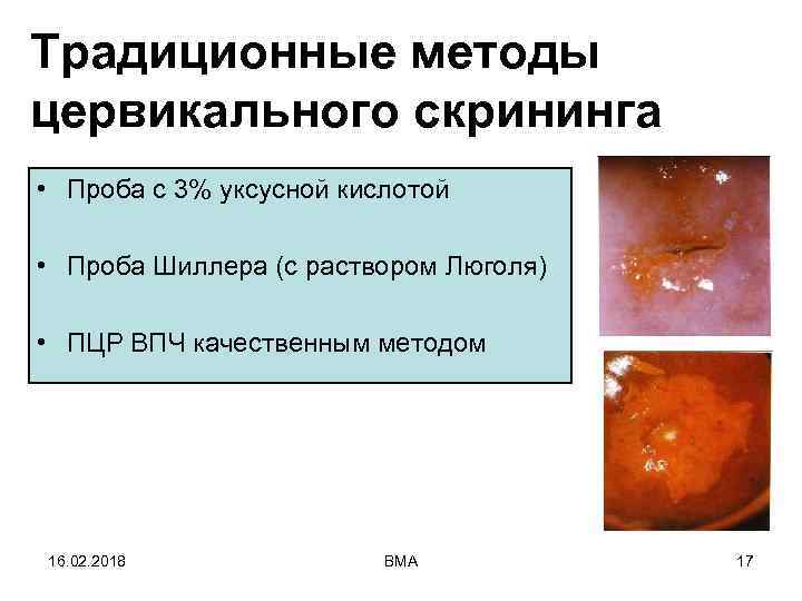 Традиционные методы цервикального скрининга • Проба с 3% уксусной кислотой • Проба Шиллера (с