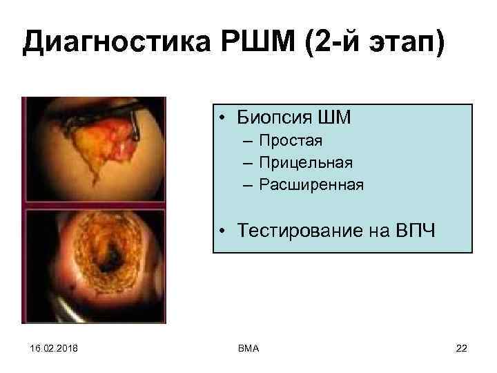 Диагностика РШМ (2 -й этап) • Биопсия ШМ – Простая – Прицельная – Расширенная