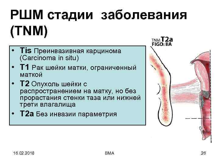 РШМ стадии заболевания (TNM) • Tis Преинвазивная карцинома (Carcinoma in situ) • T 1