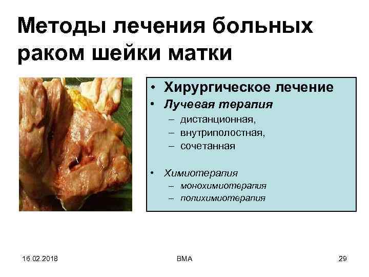 Методы лечения больных раком шейки матки • Хирургическое лечение • Лучевая терапия – дистанционная,