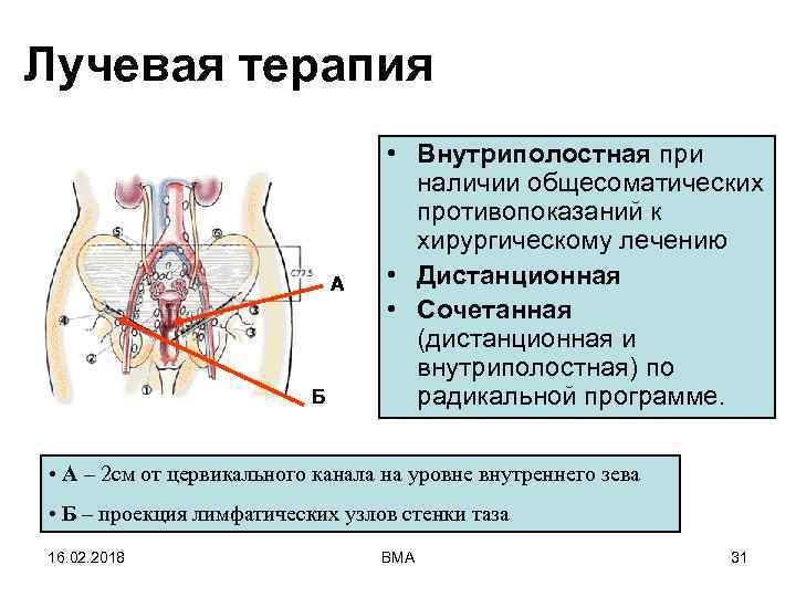Лучевая терапия А Б • Внутриполостная при наличии общесоматических противопоказаний к хирургическому лечению •