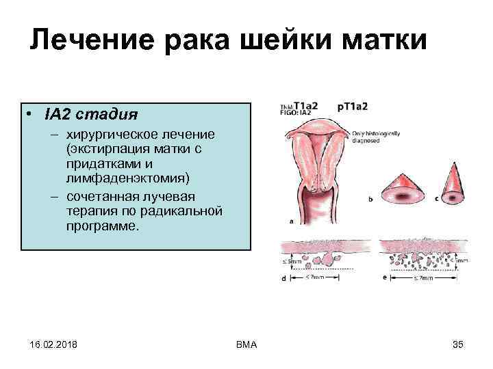 Лечение рака шейки матки • IA 2 стадия – хирургическое лечение (экстирпация матки с