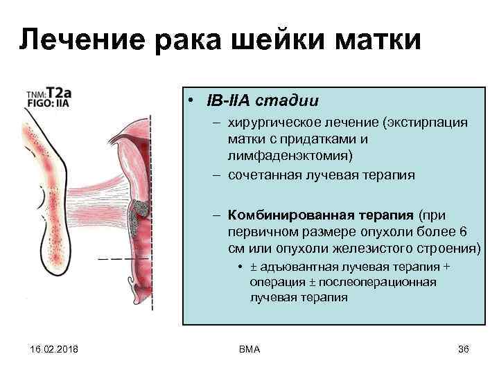 Лечение рака шейки матки • IB-IIA стадии – хирургическое лечение (экстирпация матки с придатками