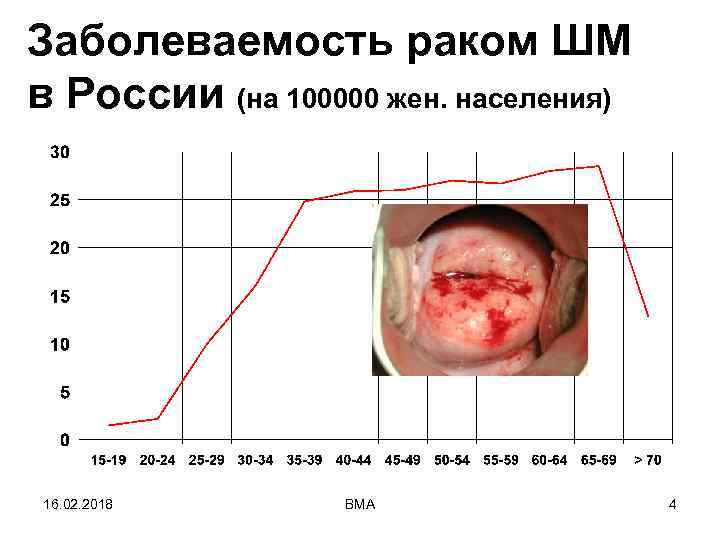 Заболеваемость раком ШМ в России (на 100000 жен. населения) 16. 02. 2018 ВМА 4
