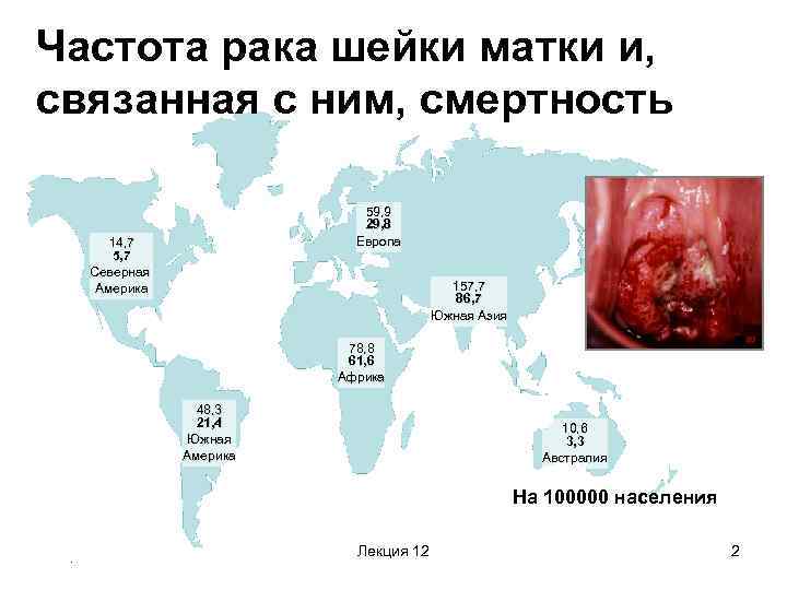 Частота рака шейки матки и, связанная с ним, смертность 59, 9 29, 8 Европа