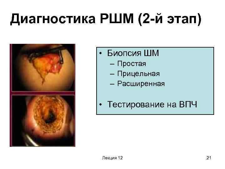 Диагностика РШМ (2 -й этап) • Биопсия ШМ – Простая – Прицельная – Расширенная