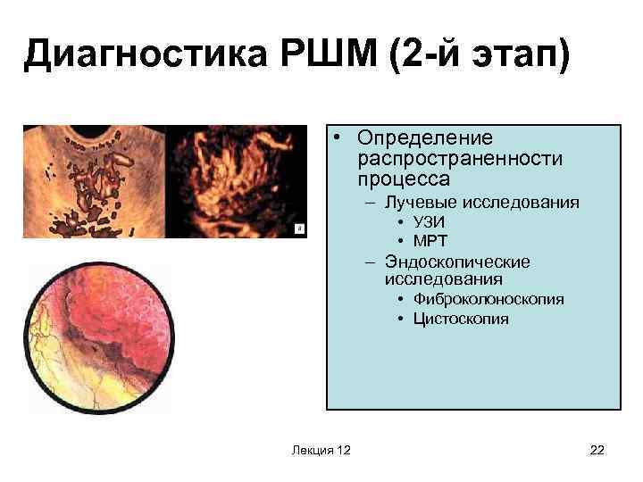 Диагностика РШМ (2 -й этап) • Определение распространенности процесса – Лучевые исследования • УЗИ
