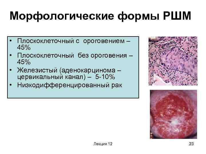 Морфологические формы РШМ • Плоскоклеточный с ороговением – 45% • Плоскоклеточный без ороговения –