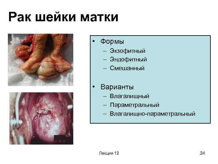Рак шейки матки • Формы – Экзофитный – Эндофитный – Смешанный • Варианты –