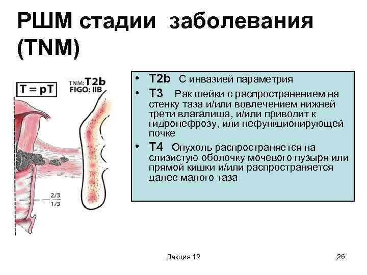 РШМ стадии заболевания (TNM) • T 2 b С инвазией параметрия • T 3