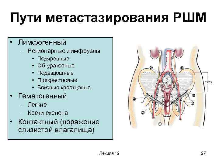 Пути метастазирования РШМ • Лимфогенный – Регионарные лимфоузлы • • • Подчревные Обтураторные Подвздошные