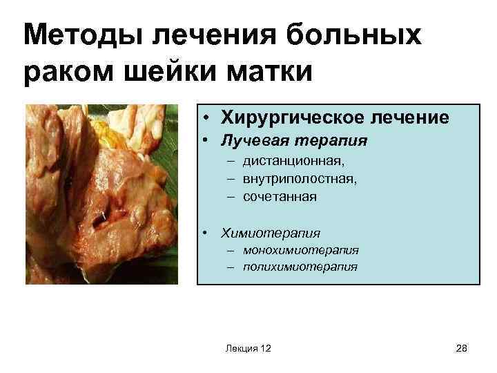 Методы лечения больных раком шейки матки • Хирургическое лечение • Лучевая терапия – дистанционная,