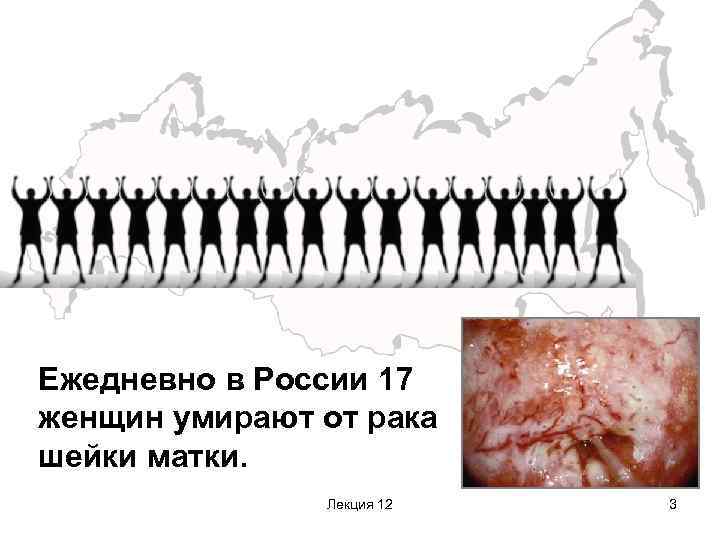 Ежедневно в России 17 женщин умирают от рака шейки матки. Лекция 12 3 