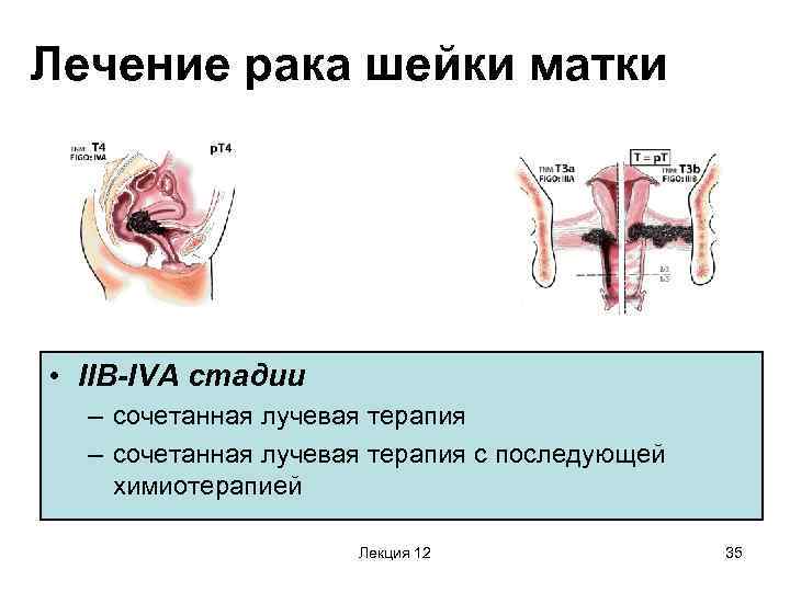 Лечение рака шейки матки • IIB-IVA стадии – сочетанная лучевая терапия с последующей химиотерапией