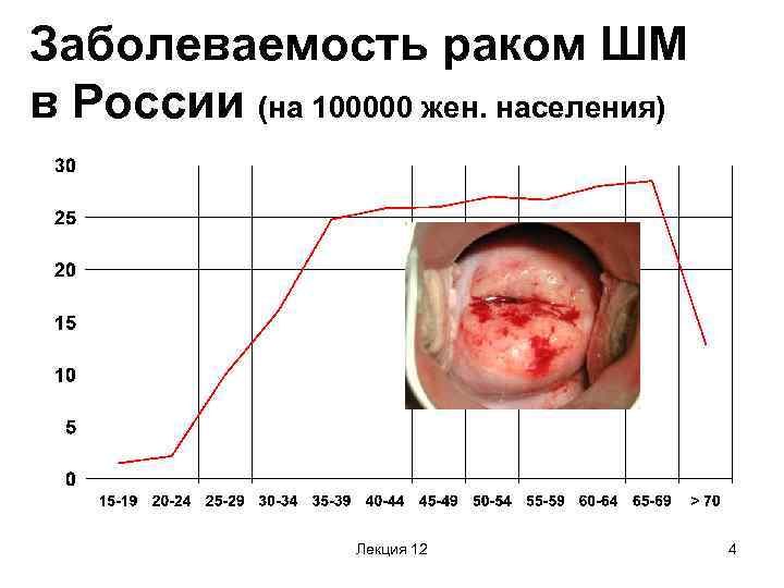 Заболеваемость раком ШМ в России (на 100000 жен. населения) Лекция 12 4 