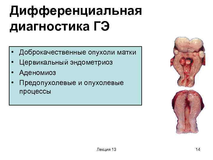 Дифференциальная диагностика ГЭ • • Доброкачественные опухоли матки Цервикальный эндометриоз Аденомиоз Предопухолевые и опухолевые