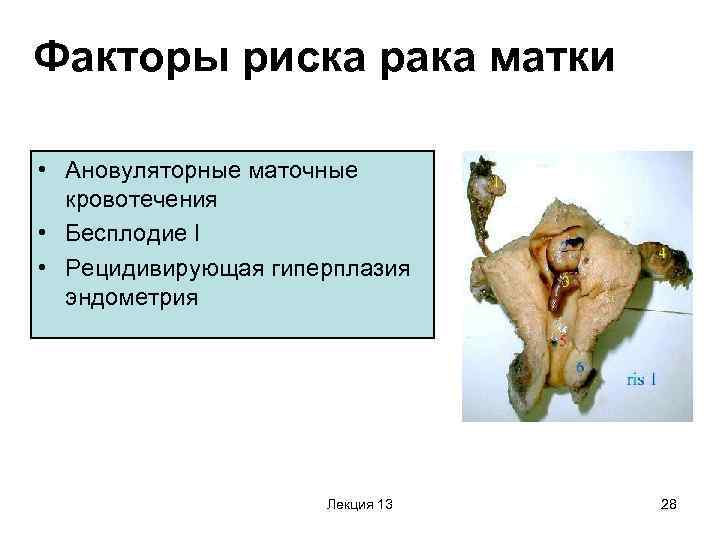 Факторы риска рака матки • Ановуляторные маточные кровотечения • Бесплодие I • Рецидивирующая гиперплазия