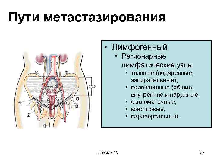 Пути метастазирования • Лимфогенный • Регионарные лимфатические узлы • тазовые (подчревные, запирательные), • подвздошные