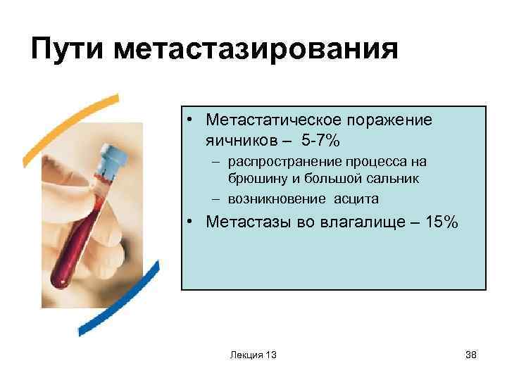 Пути метастазирования • Метастатическое поражение яичников – 5 -7% – распространение процесса на брюшину