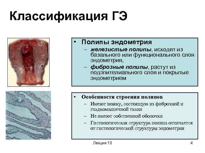 Классификация ГЭ • Полипы эндометрия – железистые полипы, исходят из базального или функционального слоя