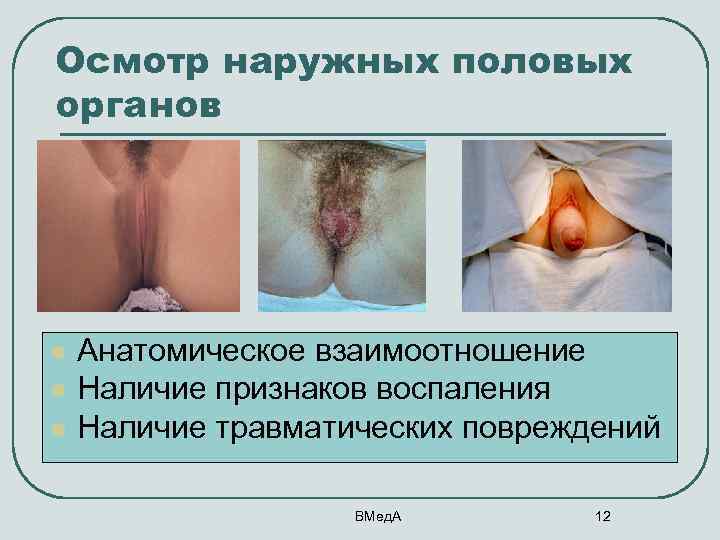 Осмотр наружных половых органов l l l Анатомическое взаимоотношение Наличие признаков воспаления Наличие травматических