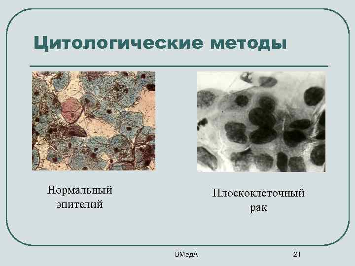 Цитологические методы Нормальный эпителий Плоскоклеточный рак ВМед. А 21 