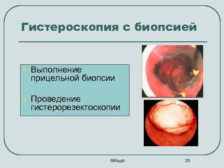Гистероскопия с биопсией l Выполнение прицельной биопсии l Проведение гистерорезектоскопии ВМед. А 35 