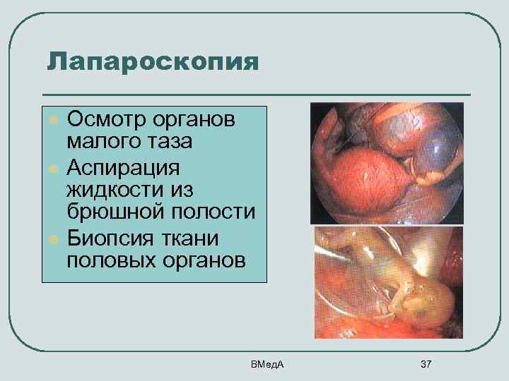 Лапароскопия l l l Осмотр органов малого таза Аспирация жидкости из брюшной полости Биопсия
