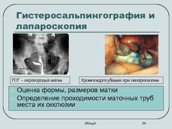 Гистеросальпингография и лапароскопия ГСГ – перегородка матки l l Хромогидротубация при лапароскопии Оценка формы,