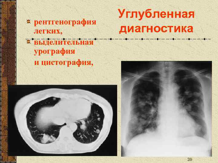 рентгенография легких, выделительная урография и цистография, Углубленная диагностика 39 