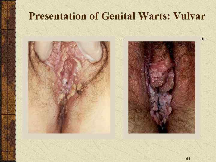 Presentation of Genital Warts: Vulvar 81 