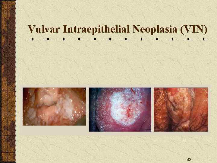 Vulvar Intraepithelial Neoplasia (VIN) 82 