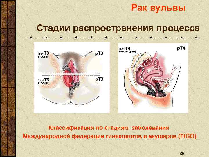 Рак вульвы Стадии распространения процесса Классификация по стадиям заболевания Международной федерации гинекологов и акушеров