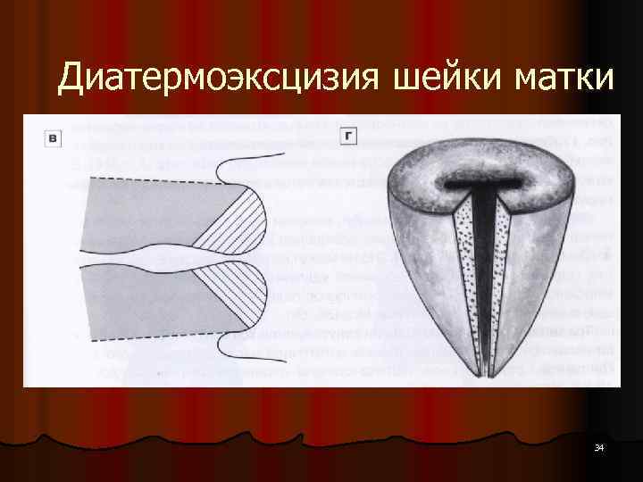 Шейка матки конической формы. Диатермоэксцизия шейки матки. Петлевая эксцизия шейки. Конусная эксцизия шейки. Конизация диатермокоагуляция шейки матки.